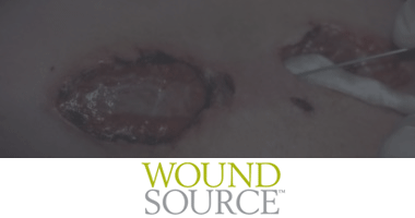 How to Assess Wounds for Tunneling and Undermining - Wound Care Weekly