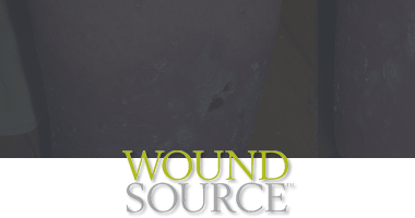 Wound Source