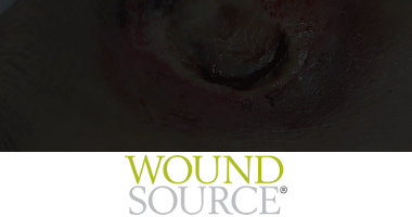 WoundSource